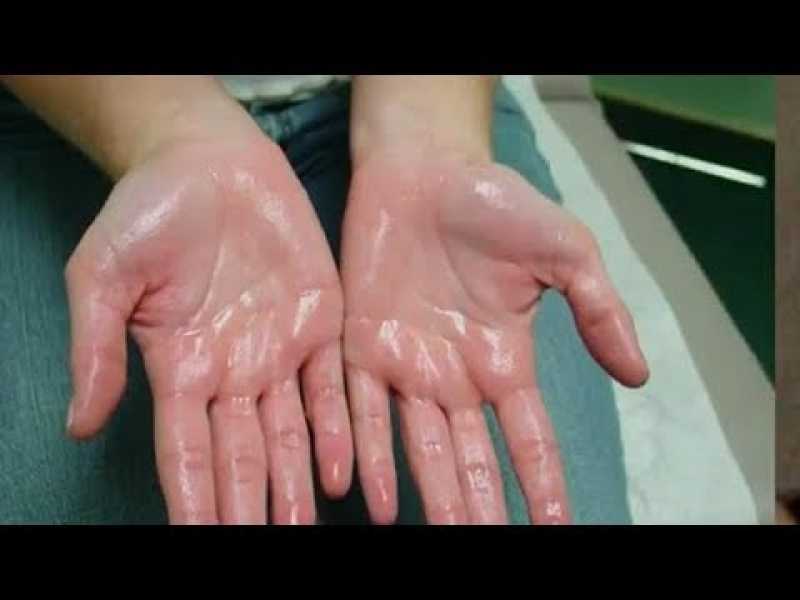 How to cure hyperhidrosis, stop excessive sweating in hands, armpits and body