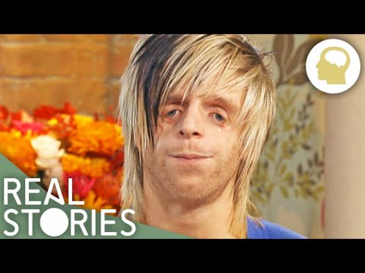 Jono: Love Me, Love My Face (Medical Documentary) | Real Stories